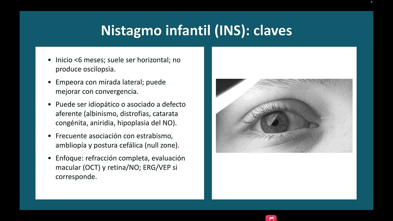 Nistagmo