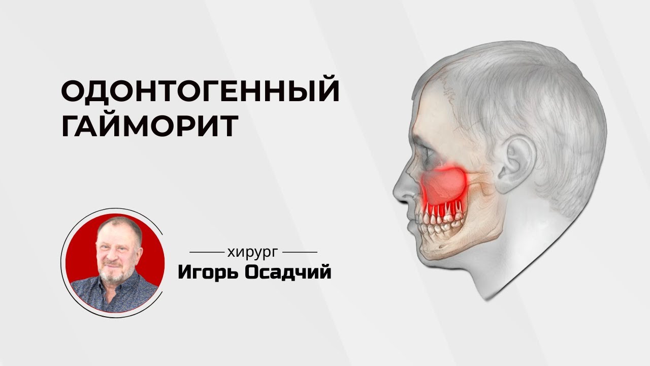 Одонтогенный или стоматологический гайморит