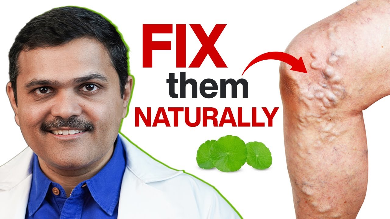 IMPROVE Your Varicose Veins FAST With These Simple Tricks!