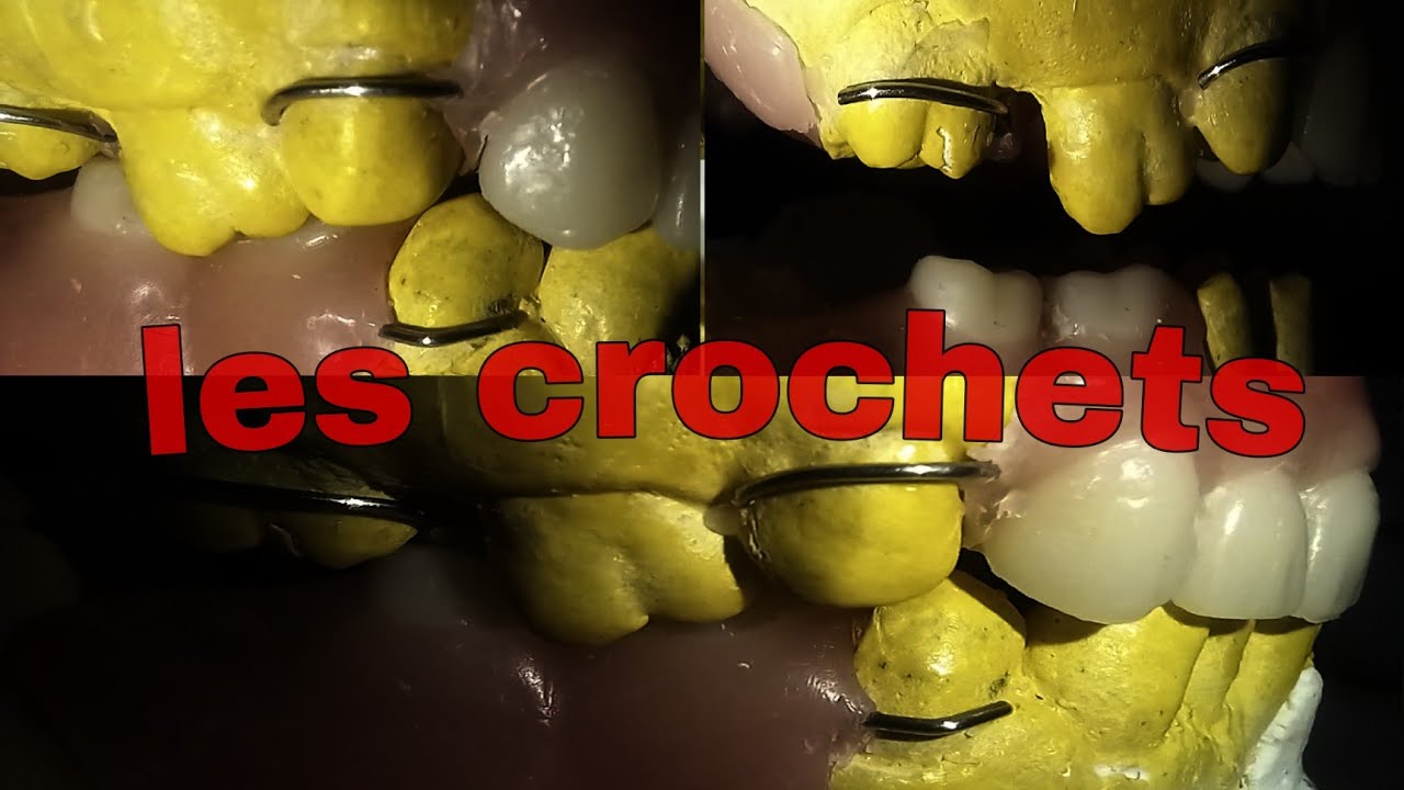 Façonnage d'un crochet sur la prémolaire