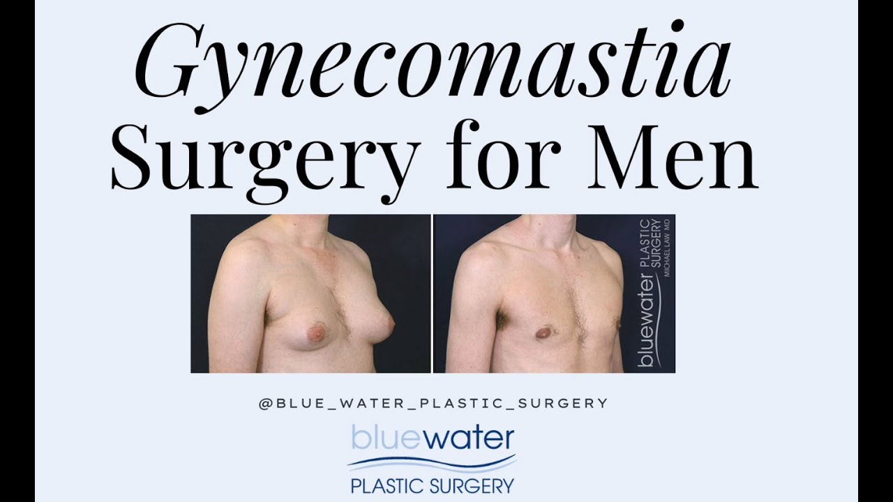 Gynecomastia Reduction Surgery - Male Breast Reduction Surgery