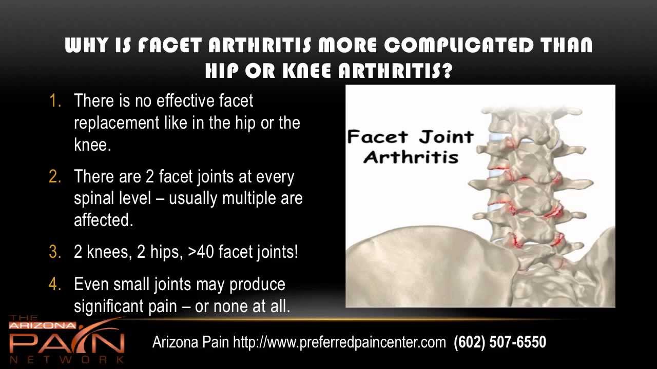Basics of Facet Syndrome (Facet Arthritis) from an AZ pain clinic (602) 507-6550