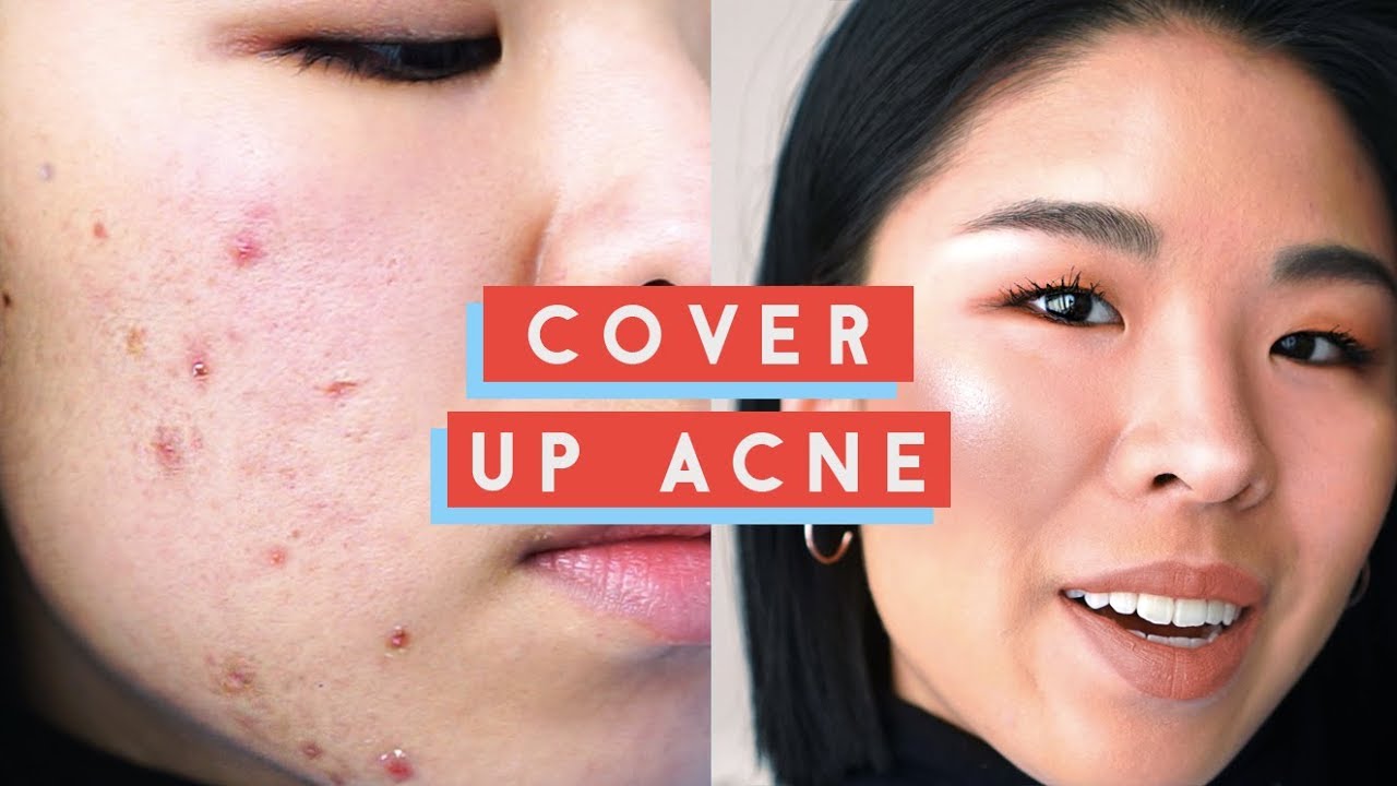 How to Cover Up Acne - My Secret to Concealing WHILE HEALING bumpy, flaky skin