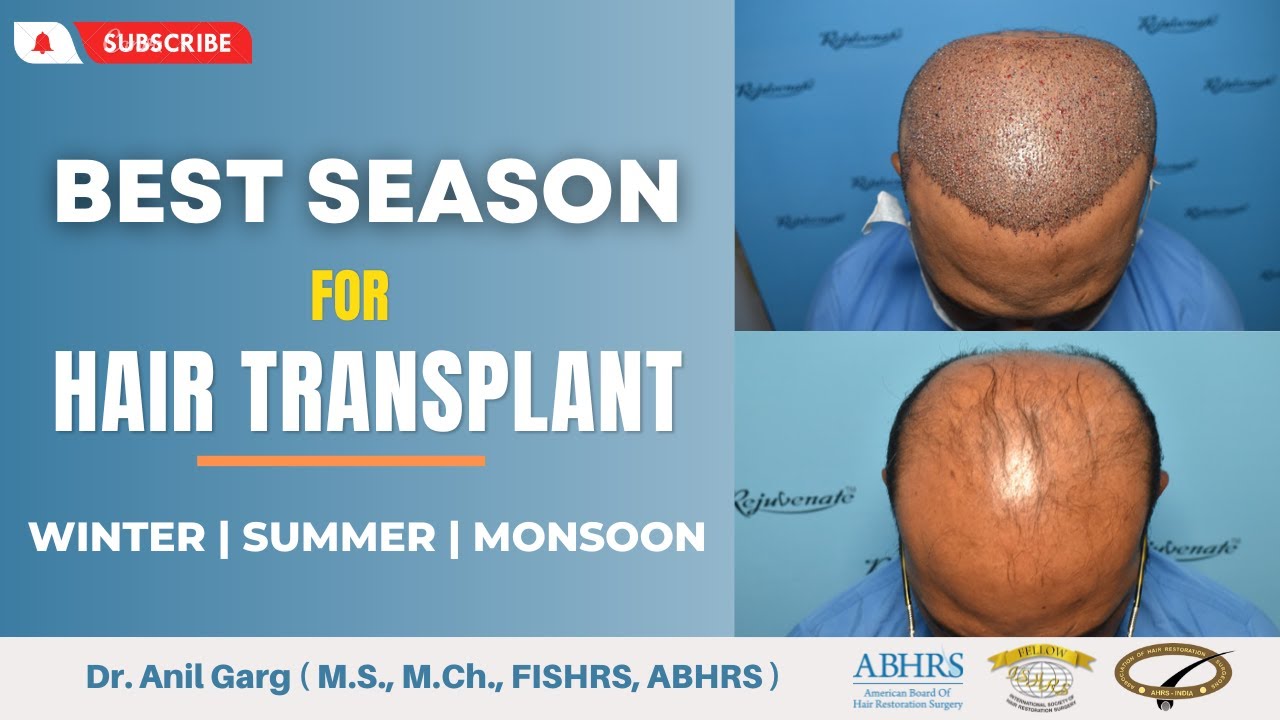 Best Season For Hair Transplant | Winter | Summer | Monsoon | Dr. Garg