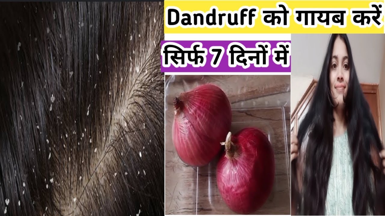 How To Cure Dandruff In 7 Days|Get Rid Of Extreme Dandruff&Hair Fall|7 दिनों में 💯% Dandruff दूर करे