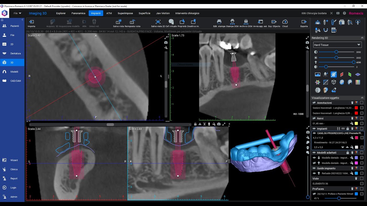Modulo Implant Guide