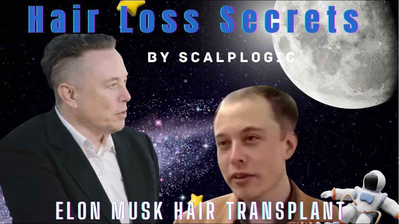 Hair Loss Secrets | Elon Musk Hair Transplant |