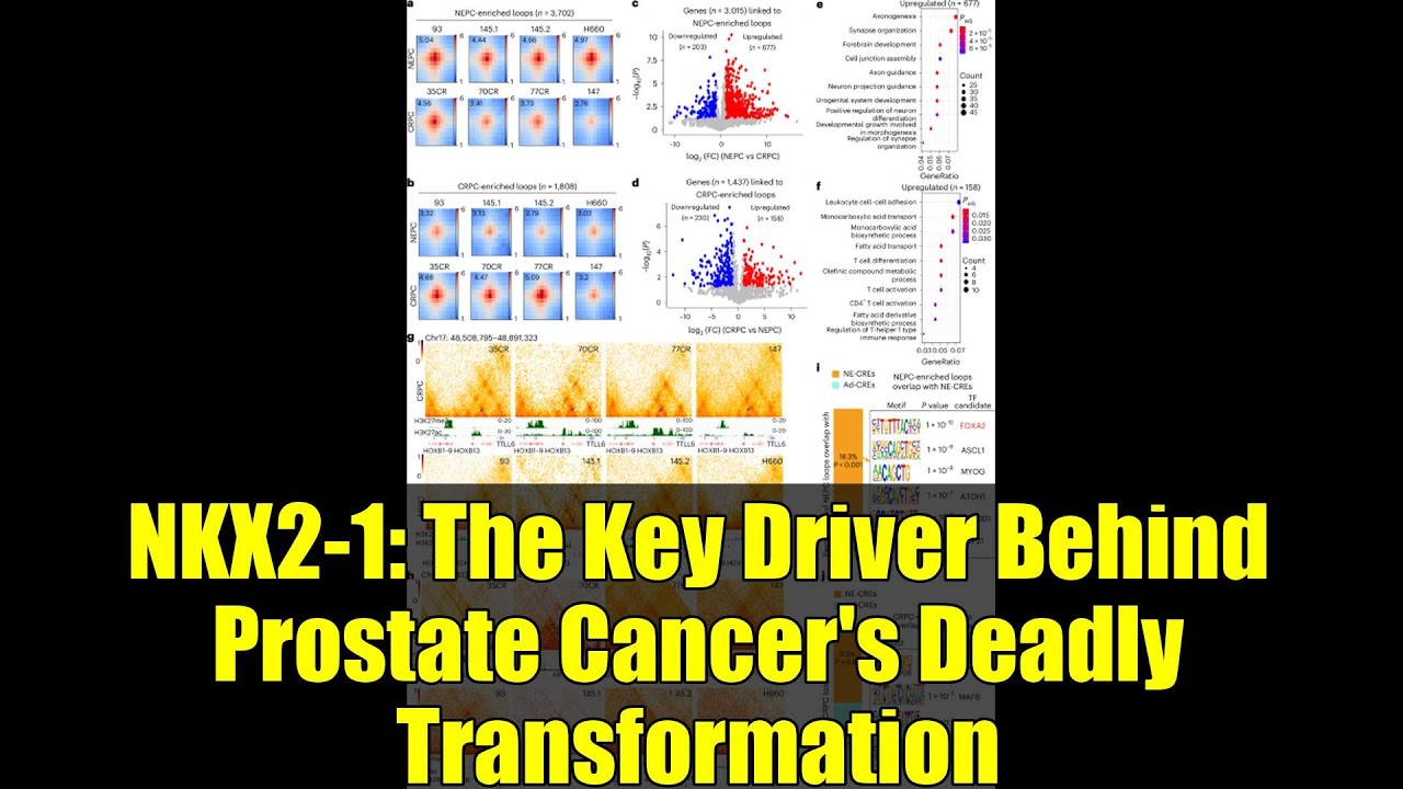 NKX2-1: The Key Driver Behind Prostate Cancer's Deadly Transformation