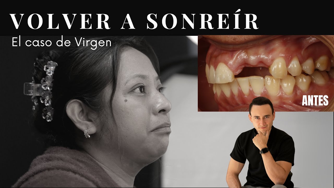 🥲Su reacción al verse dientes nuevos | implantes dentales estéticos