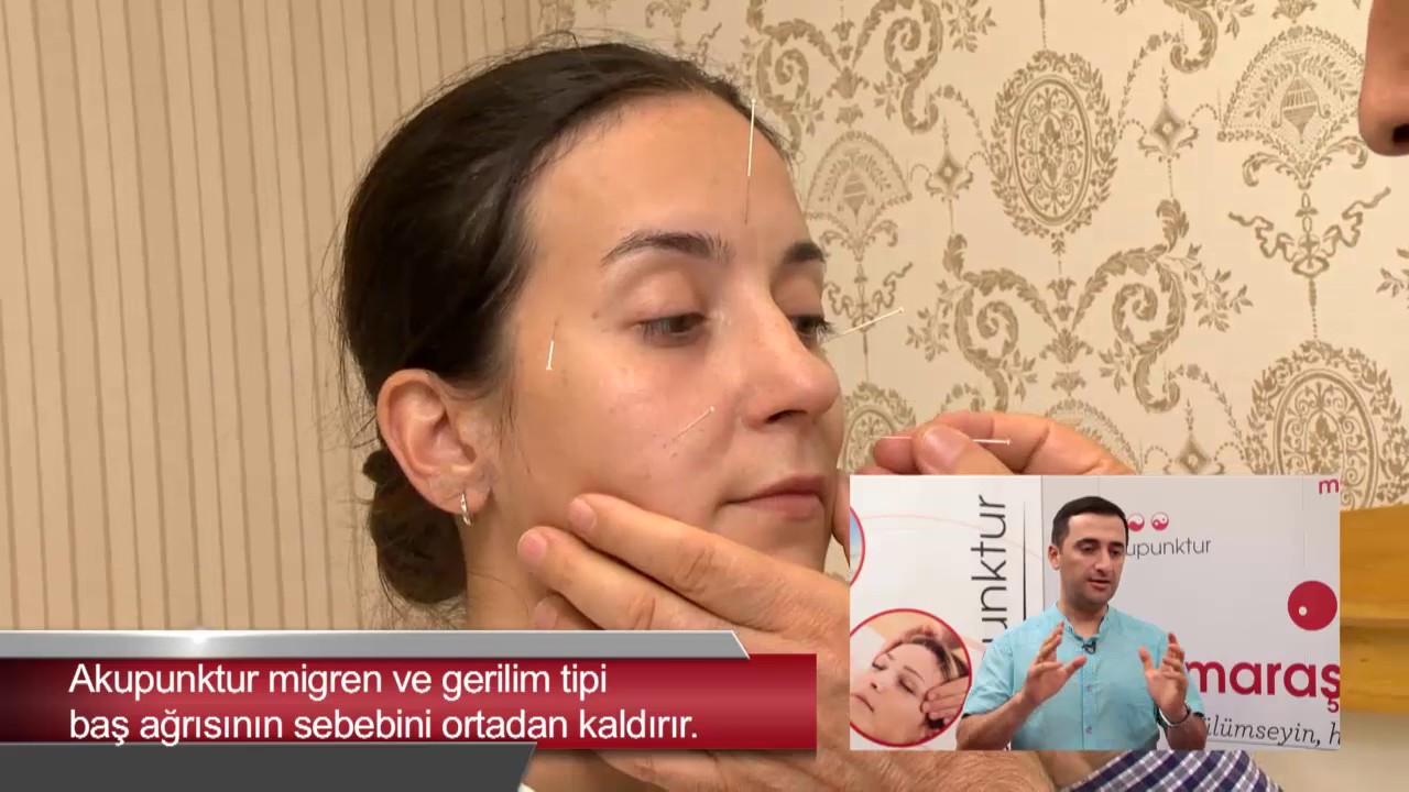 MİGREN , GERİLİM TİPİ , KÜME TİPİ BAŞ AĞRILARINDA AKUPUNKTURUN ETKİSİ NEDİR?