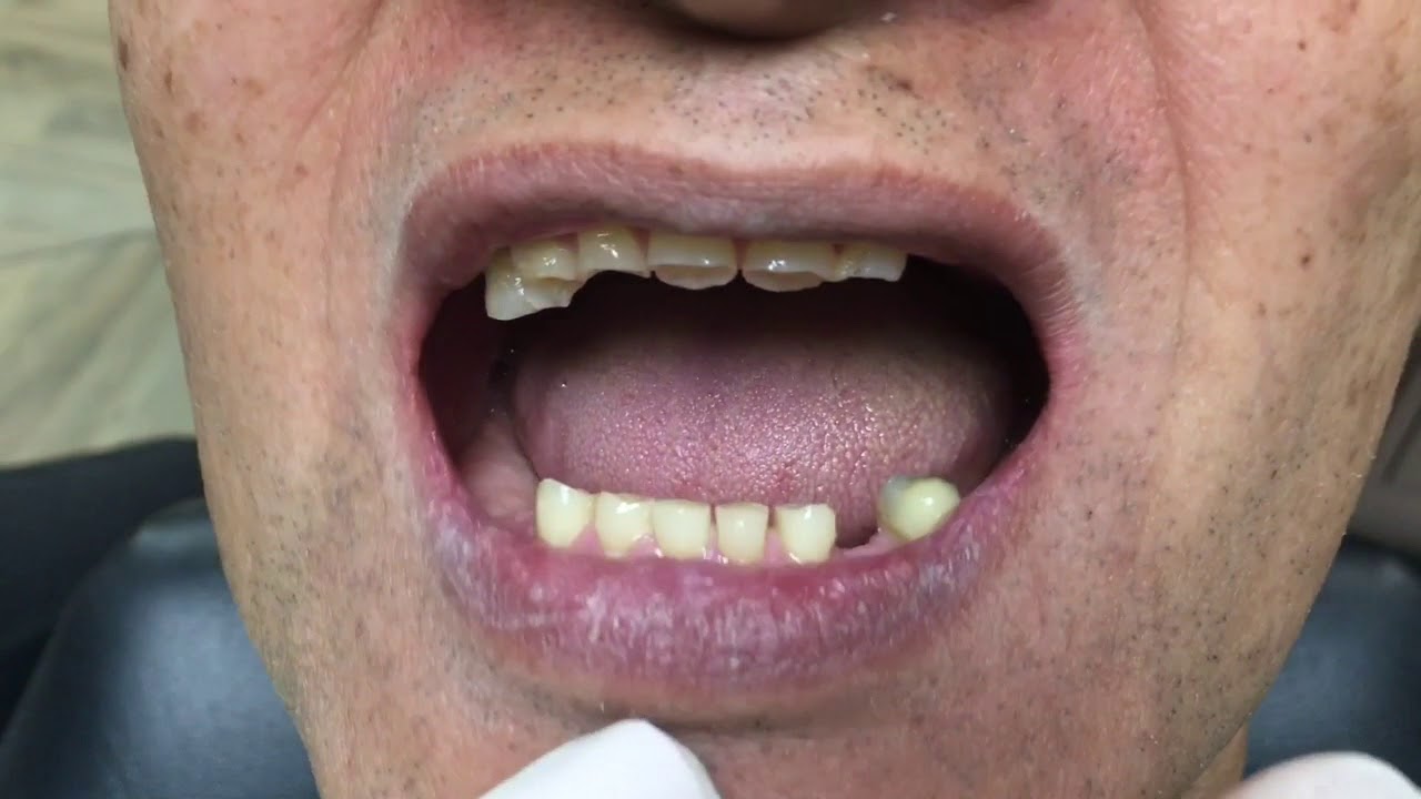 Houston Cosmetic Dentist...How to make your teeth show when you smile!