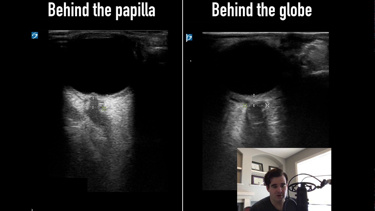 Measurement of optic nerve sheath diameter