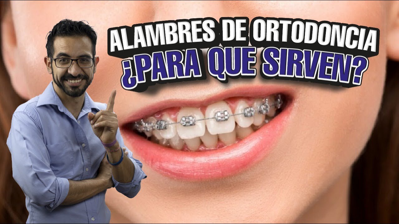 ¿Para qué sirven los alambres en un tratamiento de ortodoncia?