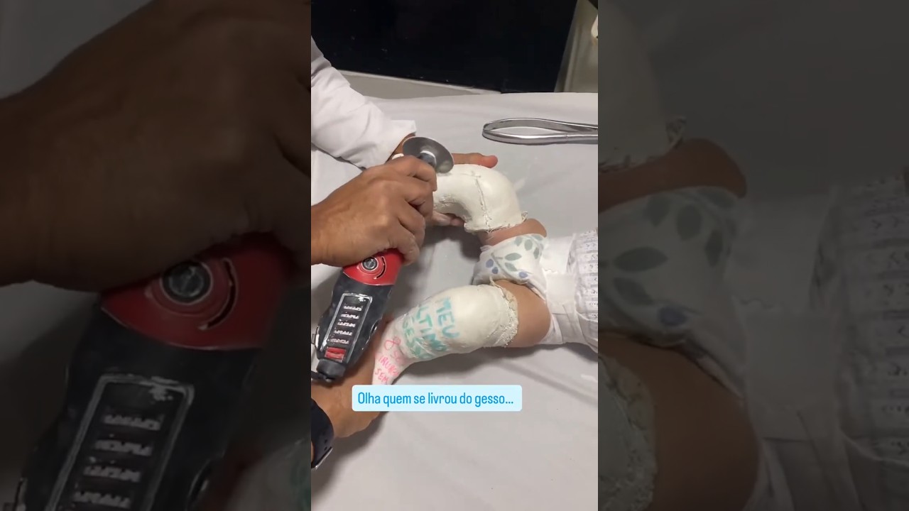 Small Baby Clubfoot Treatment | Plaster Cast Removal & Foot Correction Journey 