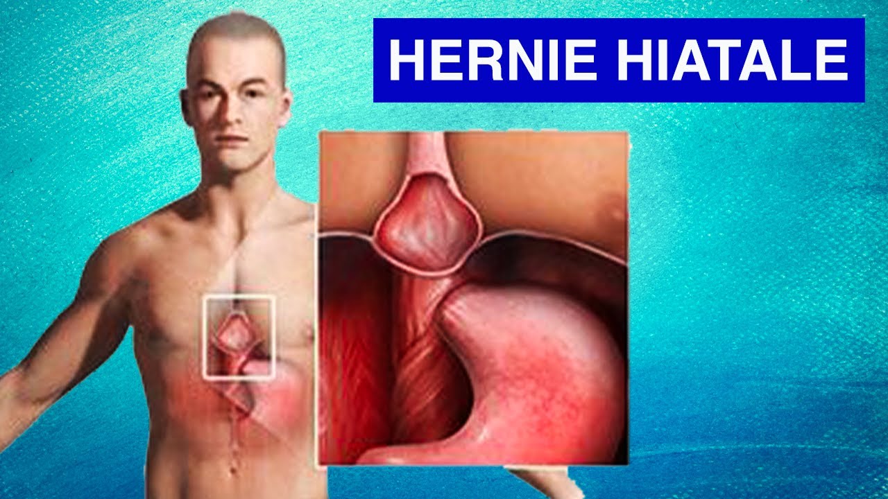 HERNIE HIATALE : Causes, Symptômes et Traitements