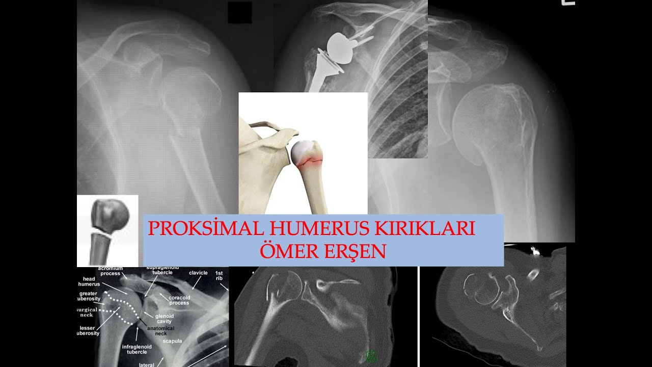 Proksimal Humerus Kırıkları - Proximal Humerus Fractures