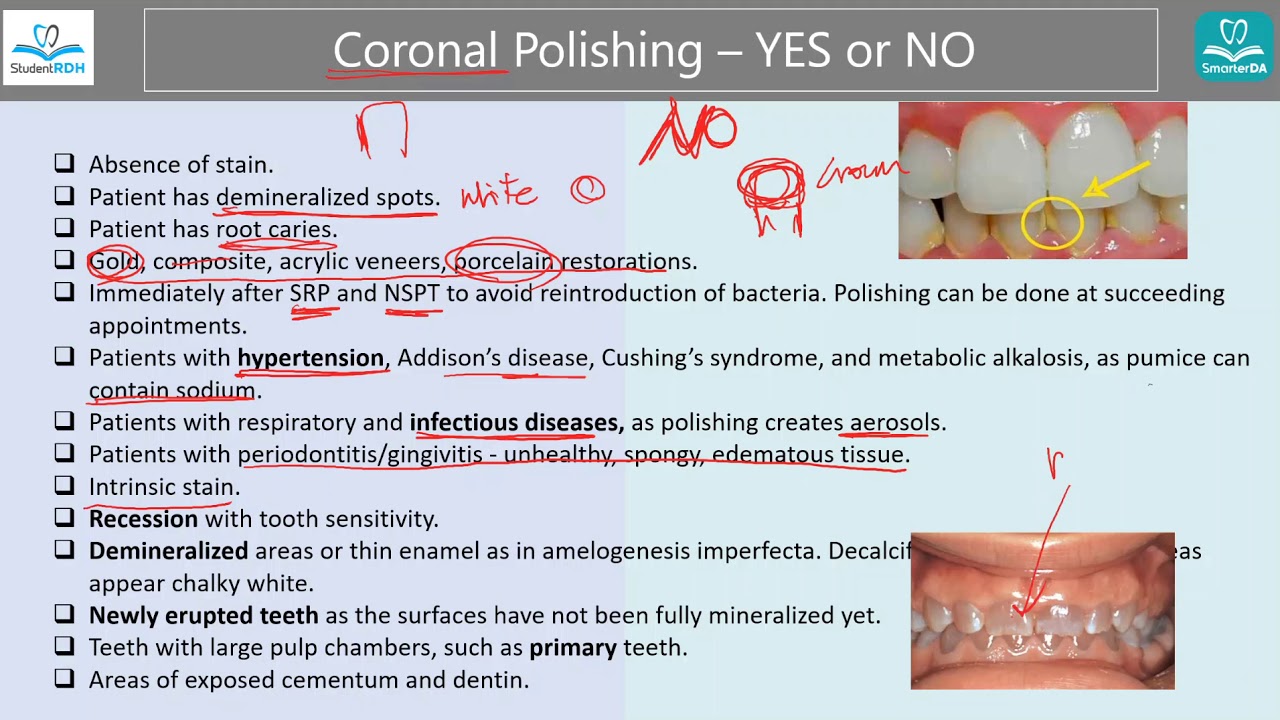 Indications and Contraindications for Coronal Polishing [StudentRDH]