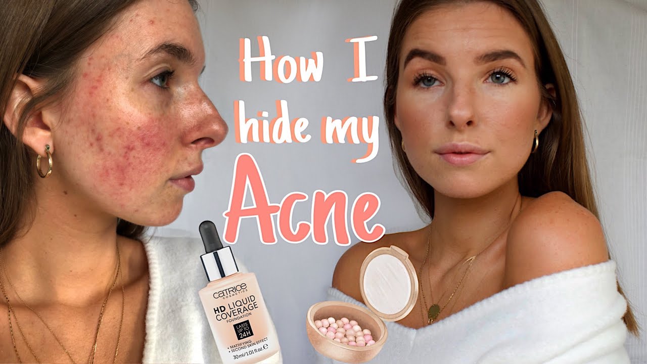 Pickel abdecken und kaschieren | Akne | Make Up