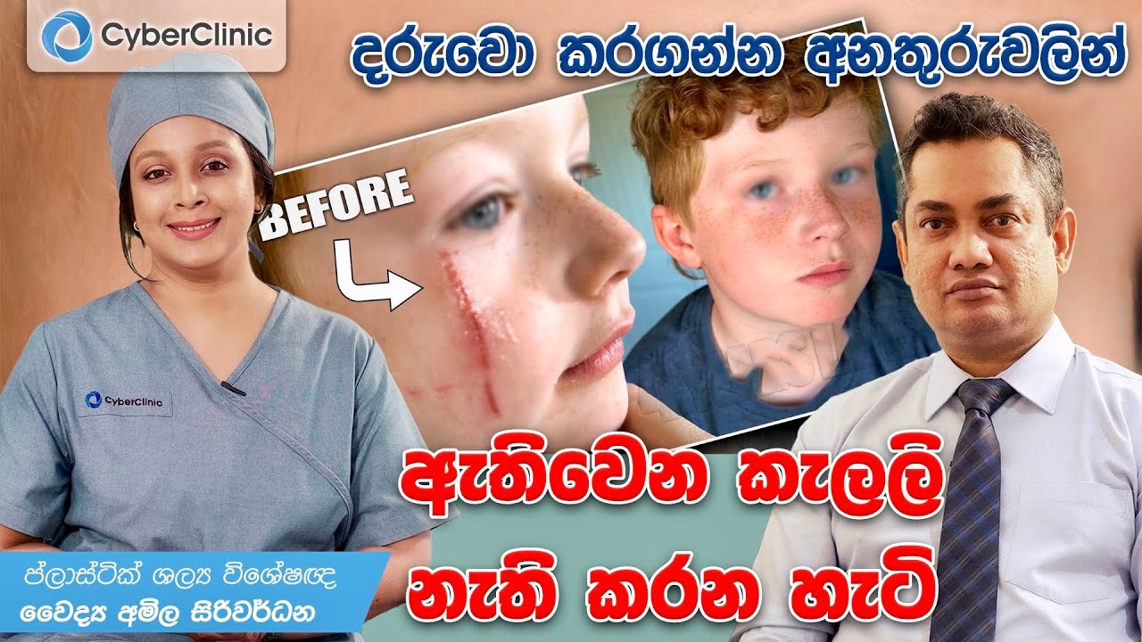 දරුවො කරගන්න අනතුරුවලින් ඇතිවෙන කැලලි නැති කරන හැටි Cyber Clinic