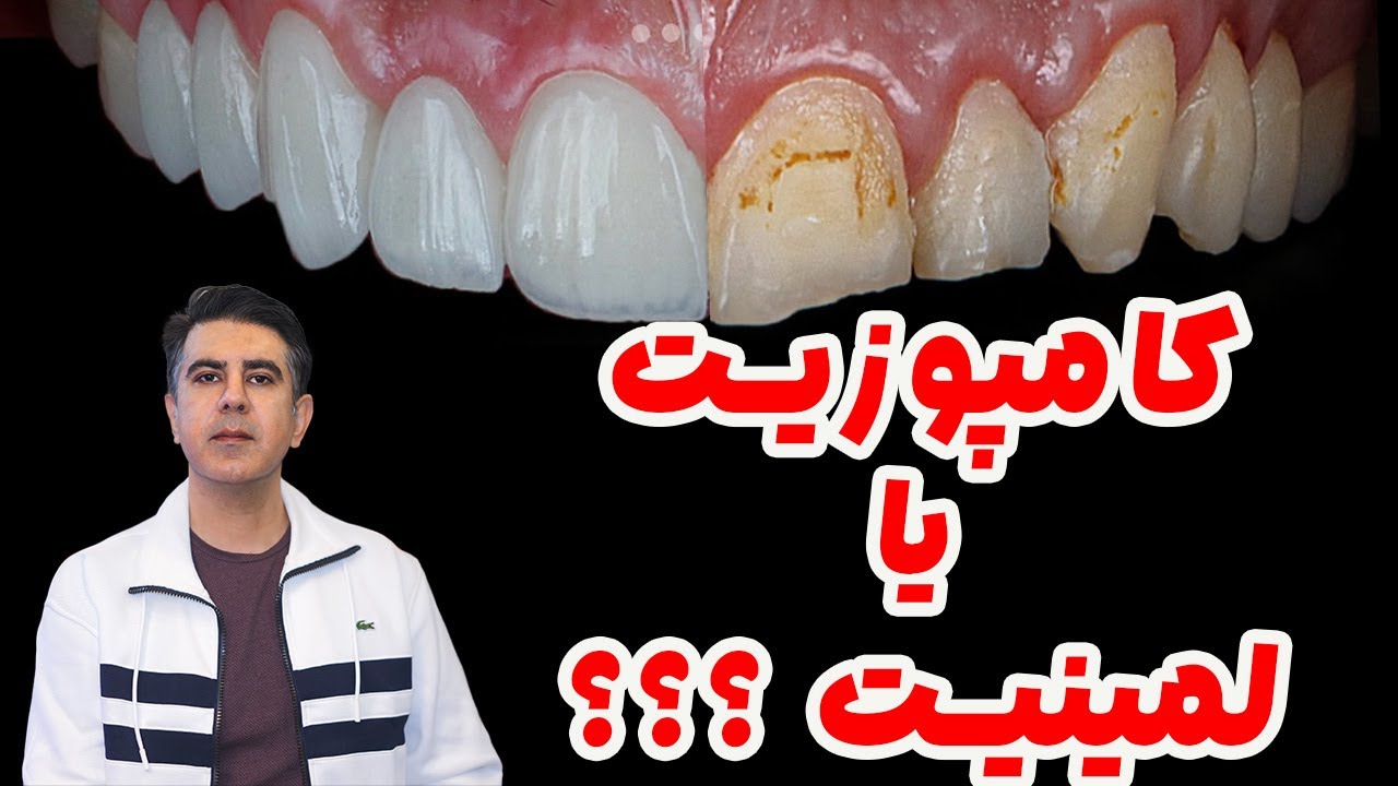 لمینیت یا کامپوزیت؟ کدوم بهتره