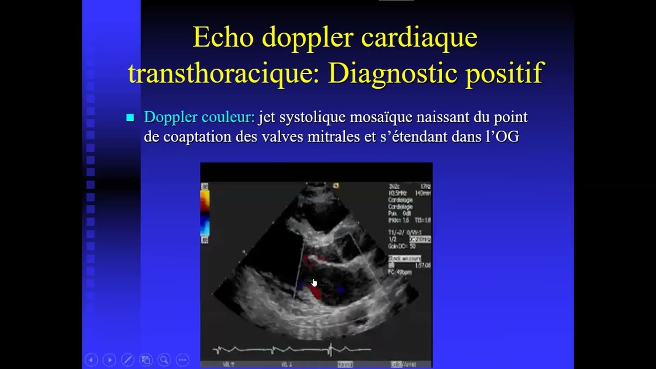 CEC échocardiaque Sfax : 