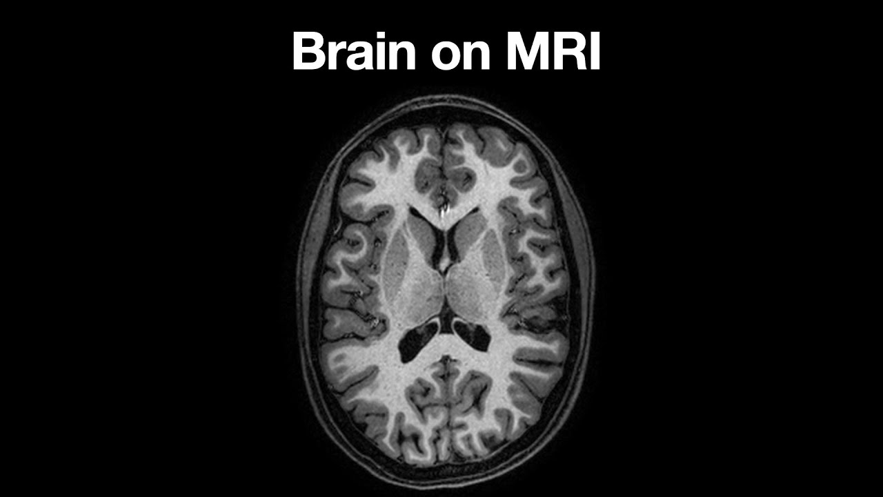 Anatomy of the Brain on MRI
