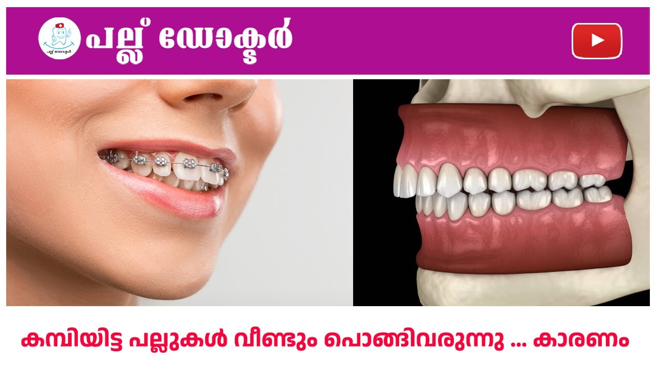 കമ്പിയിട്ട പല്ലുകൾ വീണ്ടും പൊങ്ങിവരുന്നു ..കാരണം/Braced Teeth Are Coming Back&hellip; Why Does This Happen?