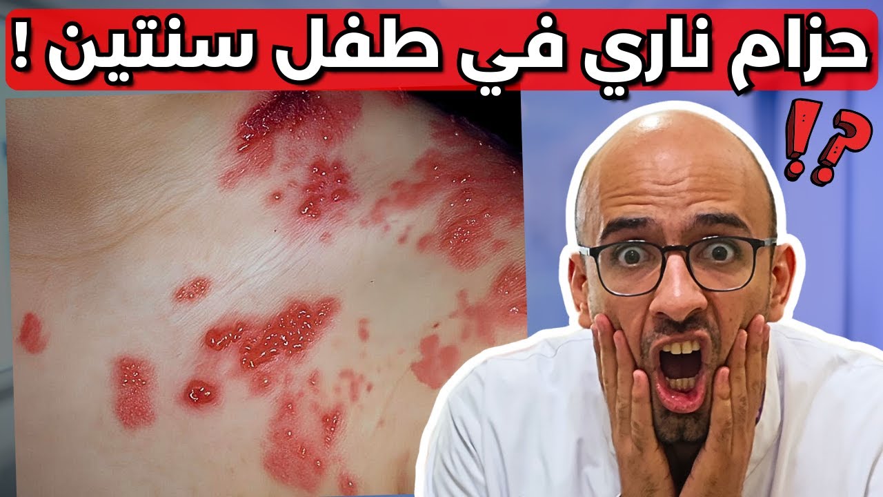 الحزام الناري في طفل عمره سنتين !! (اغرب حالة تقابلني !)