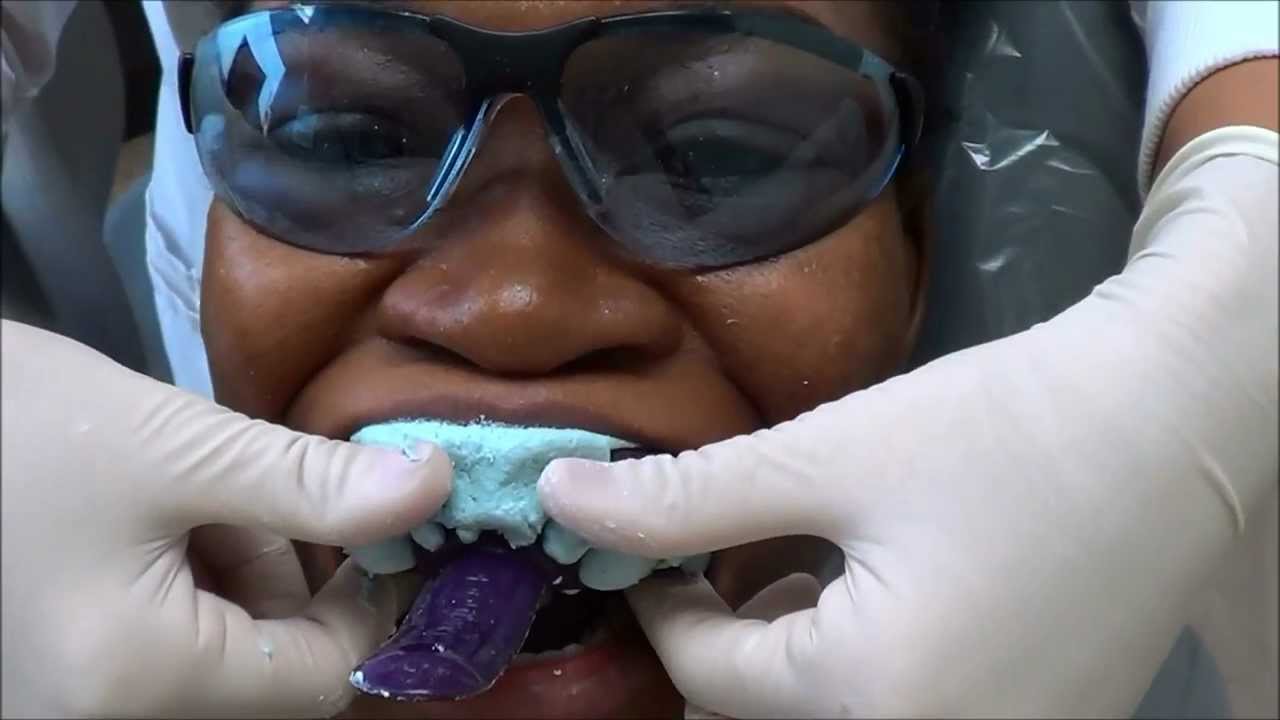 {#127} MAKING TEETH MOLDS FOR MY REMOVABLE RETAINERS