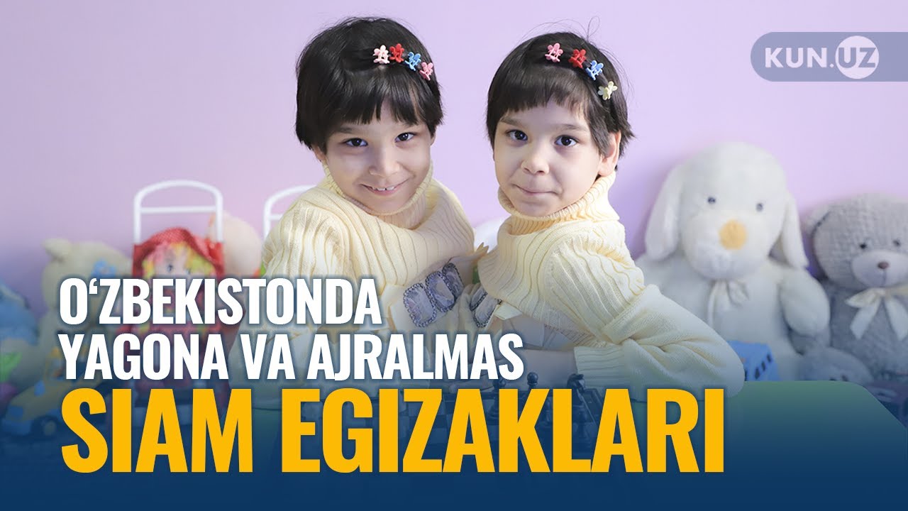 O‘zbekistondagi yagona va ajralmas siam egizaklari