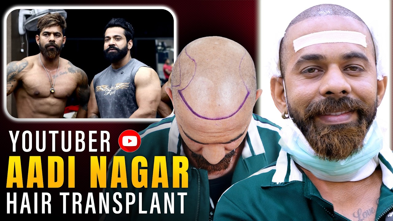 Hair Transplant in Delhi (HX-GABY) | Best Results & Cost of Hair Transplant in Delhi.
