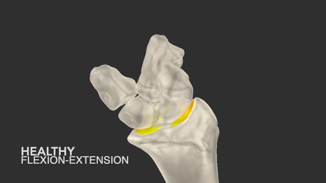 Supplemental Video 1. Carpal kinematics in Madelung Deformity.