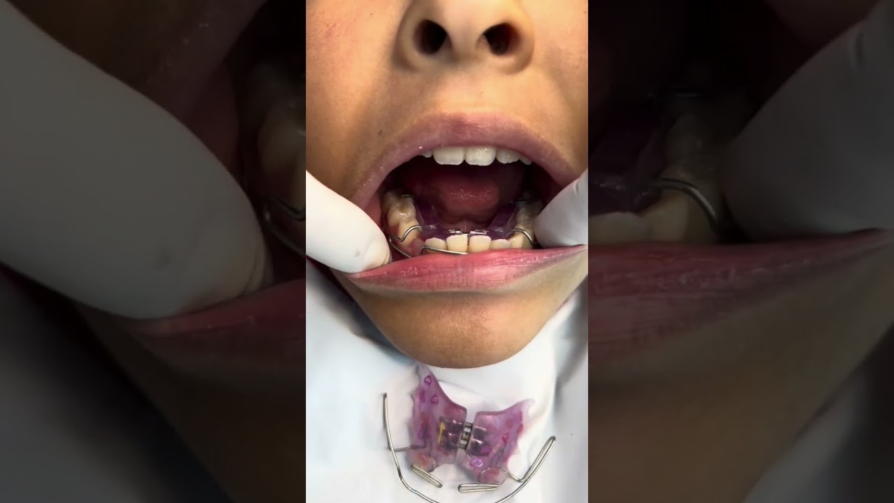 Cómo corregir los dientes chuecos desde temprana edad