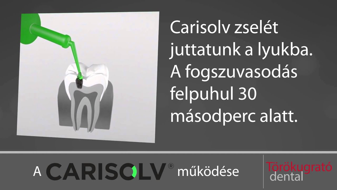 Carisolv f&uacute;r&aacute;s n&eacute;lk&uuml;li fogt&ouml;m&eacute;s: T&ouml;r&ouml;kugrat&oacute; Dental