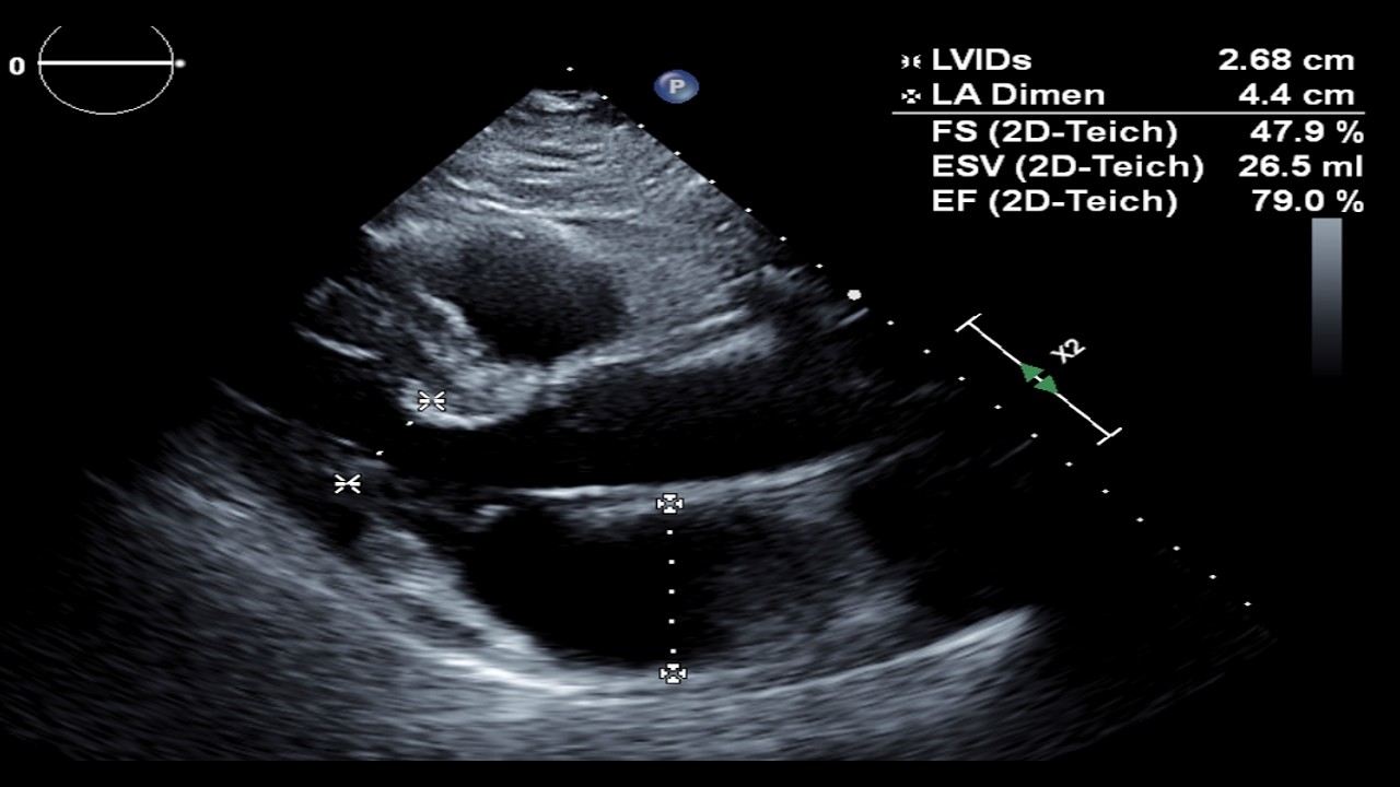 Diastolic Heart Failure