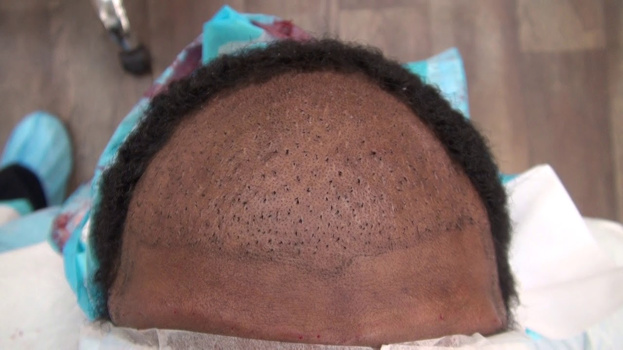 Hair Plugs & Poor Density by Other Clinic Right Before Dr. Diep Attempts To Fix Repair By FUE & FUT