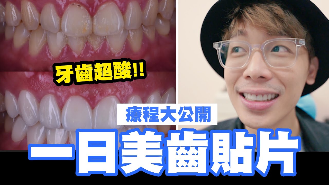 一日美齒貼片🦷🦷療程大公開✨✨牙齒超酸😣｜酷炫老師.生活VLOG