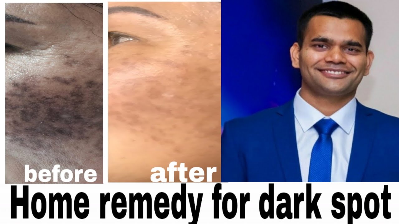 Get Rid Of Black Spots Naturally | Home remedies for dark spots | Dr. Vivek joshi