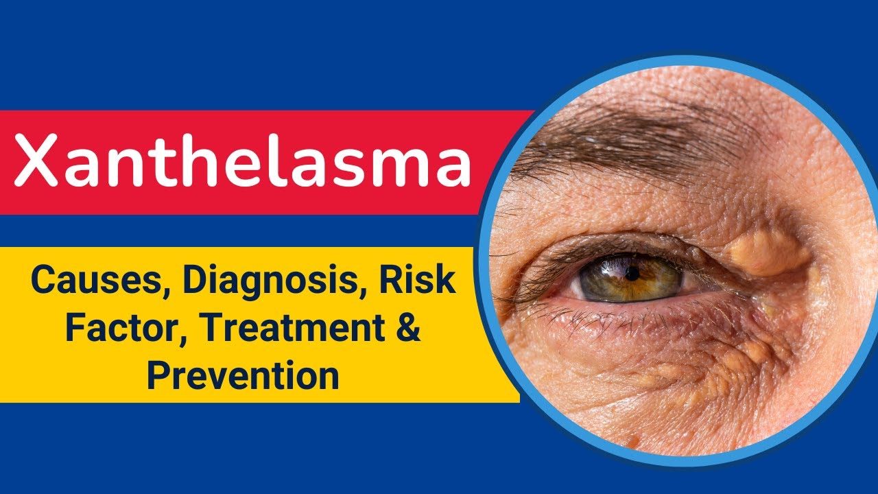 Xanthelasma: Meaning, Causes, Diagnosis, Risk Factor, Treatment & Prevention | Xanthelasma Treatment