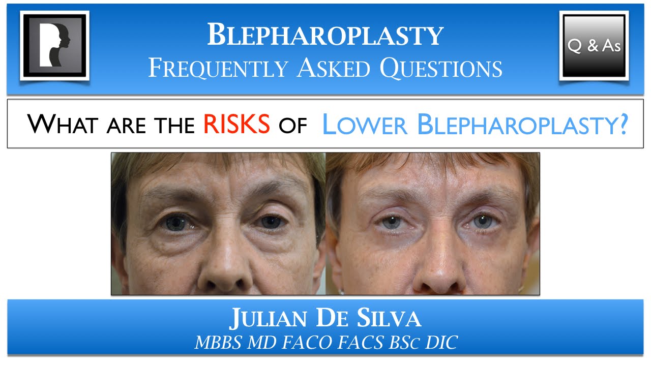 Risks of Lower Blepharoplasty | Lower Eyelid Surgery FAQ
