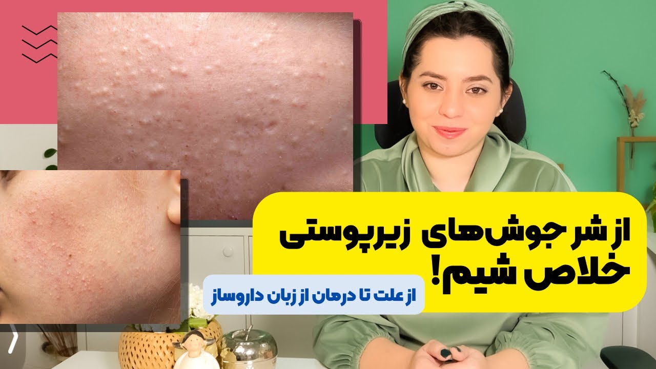 از تشخیص تا درمان جوش‌زیرپوستی:بایدها و نبایدها در درمان‌کامل جوش‌زیرپوستی و داشتن پوست صاف
