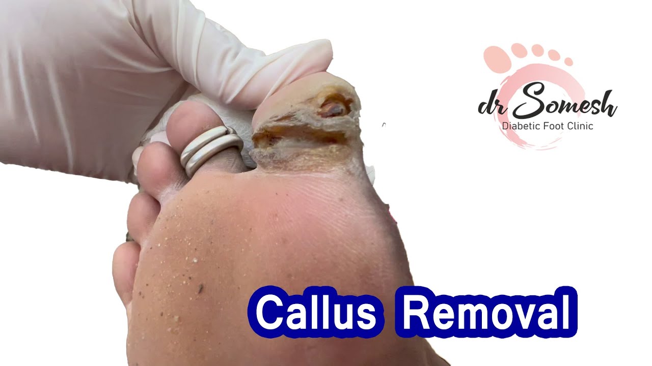 #callus Removal