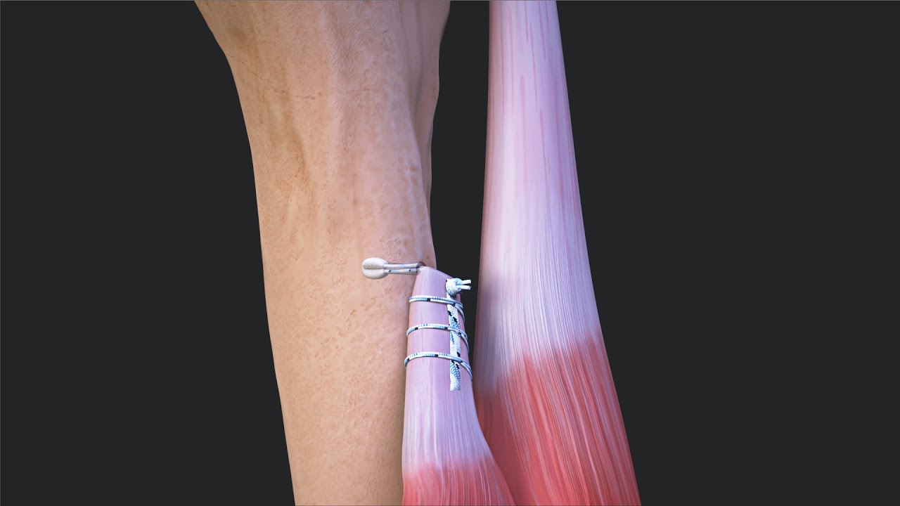 Subpectoral Biceps Tenodesis With FiberTak® Button and SutureTag Looping Stitch