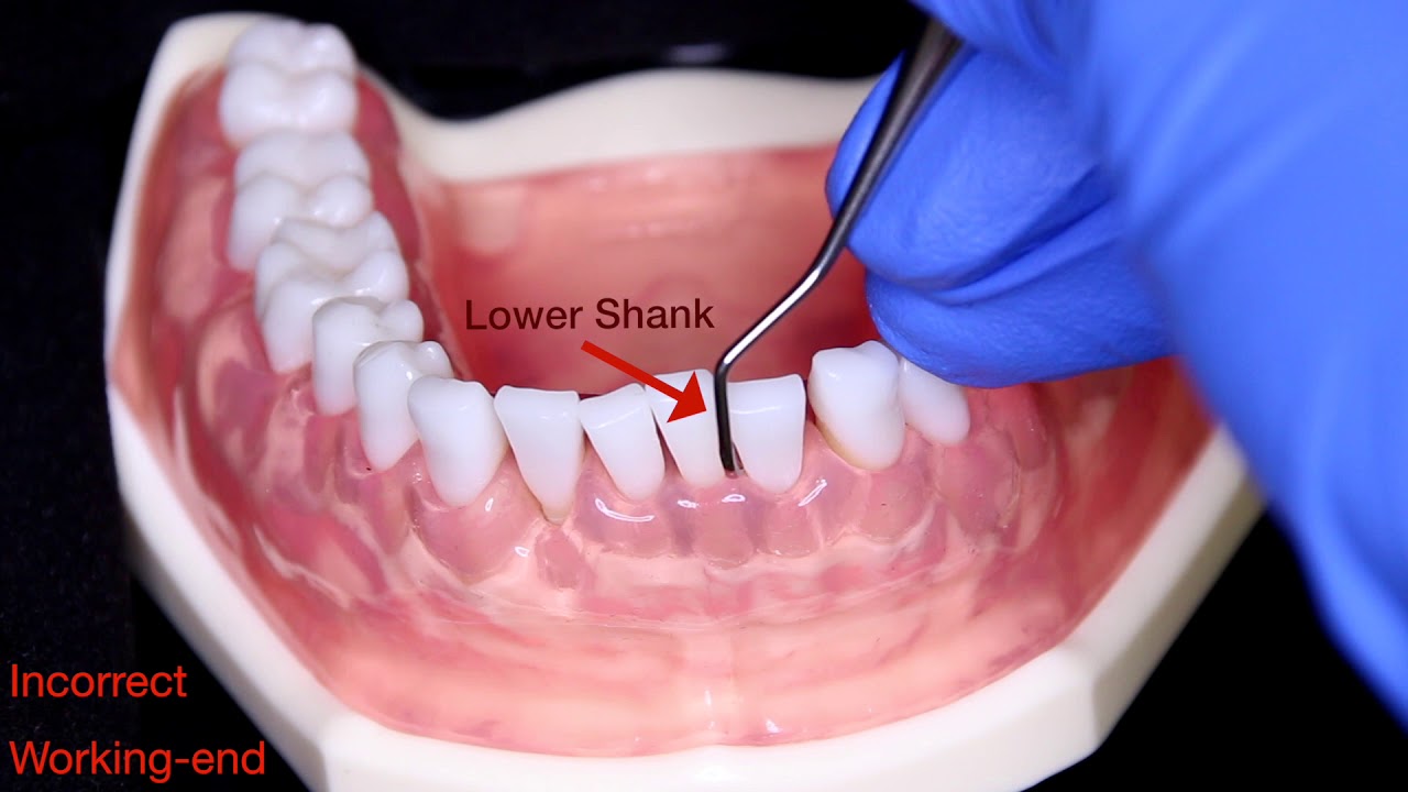Universal Curet, Anterior Technique
