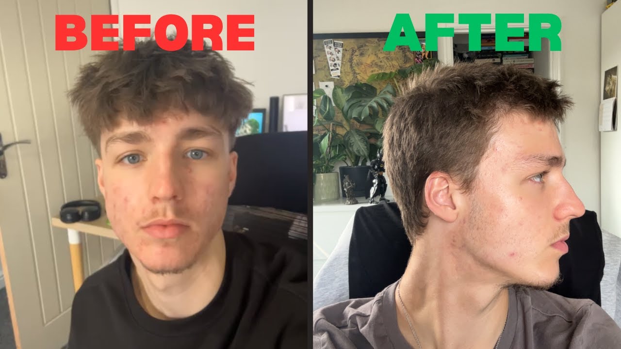 How I fixed my acne...