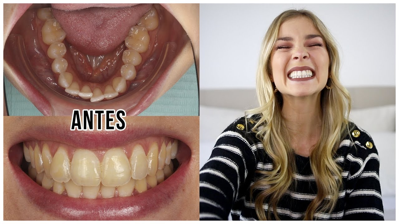 COMO TRANSFORMEI O MEU SORRISO! Com fotos e vídeos | Alice Trewinnard