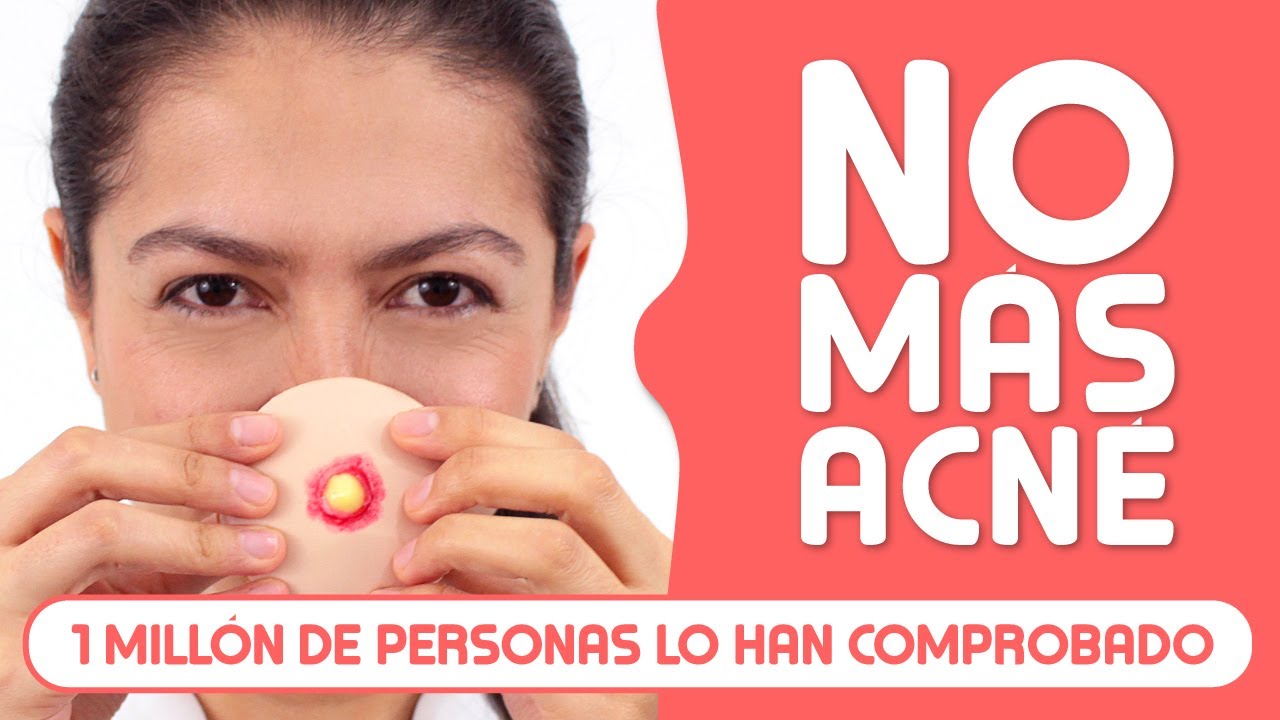 ¡CURA el ACNÉ YA! Remedios NATURALES, Causas, Mitos y MÁS
