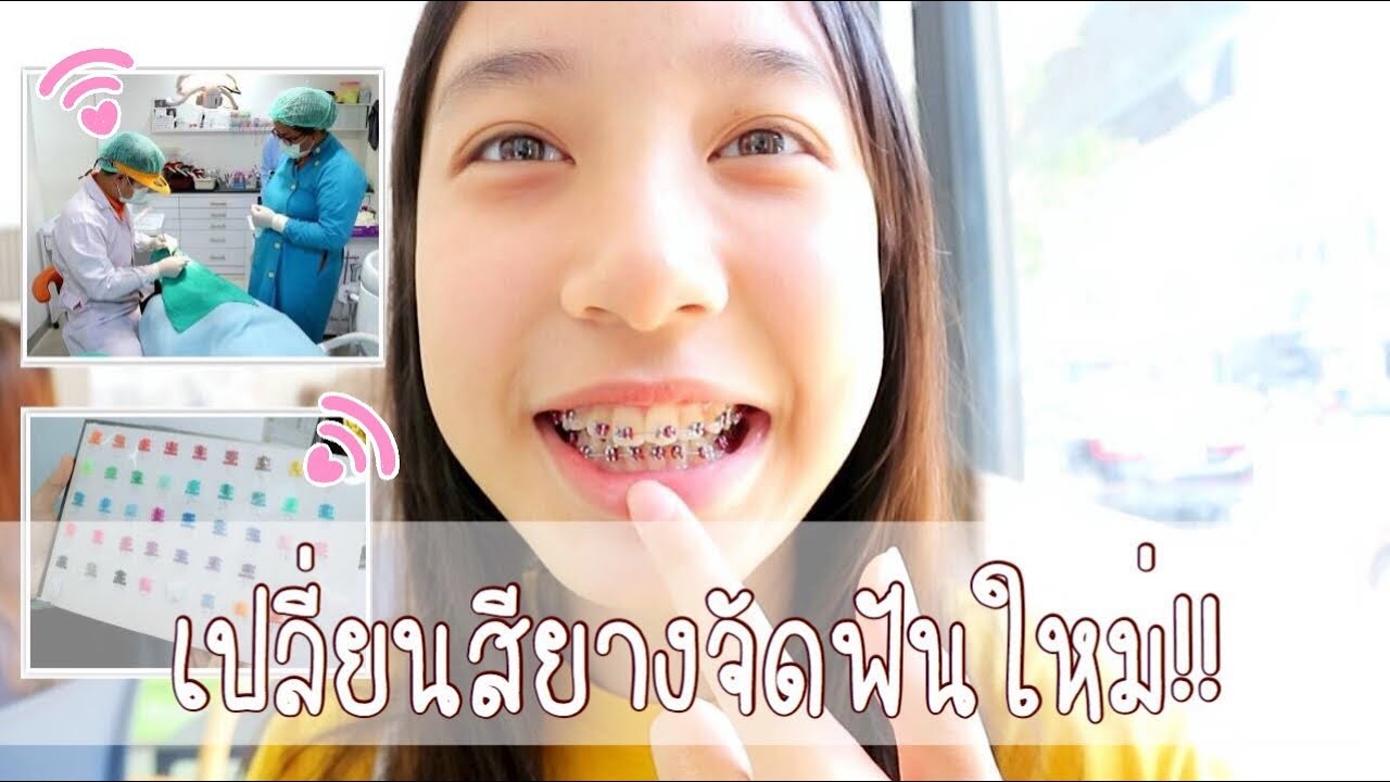 เปลี่ยนสียาง อัพเดทหลังจากจัดฟัน1เดือน ep.2 | Mink Mink