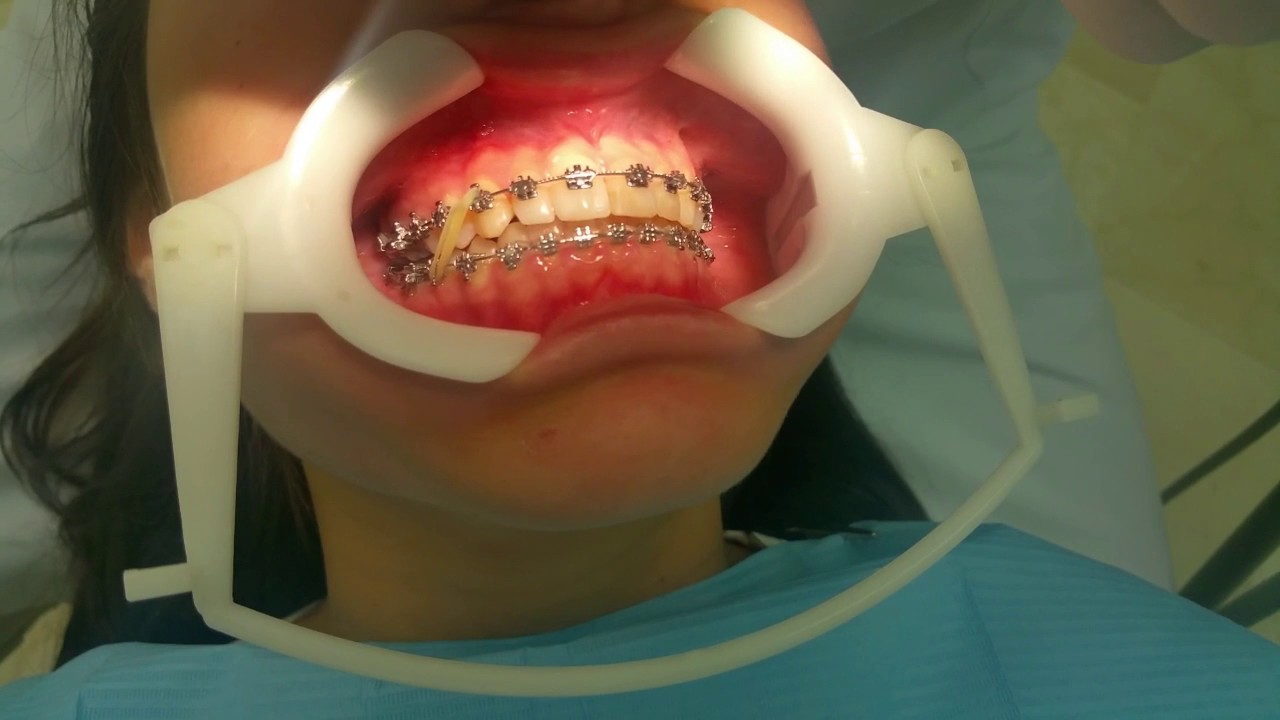 USO DE LOS ELÁSTICOS INTERMAXILARES - CLÍNICA ORTODONCIA DR GALLARDO