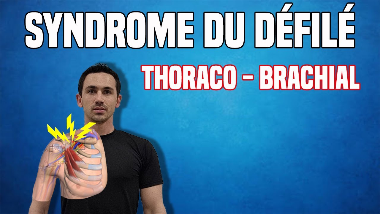 SYNDROME DU DÉFILÉ THORACO-BRACHIAL : EXERCICES DE RÉÉDUCATION (KINÉ)